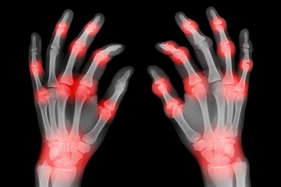 Omega-3s to relieve arthritis pain